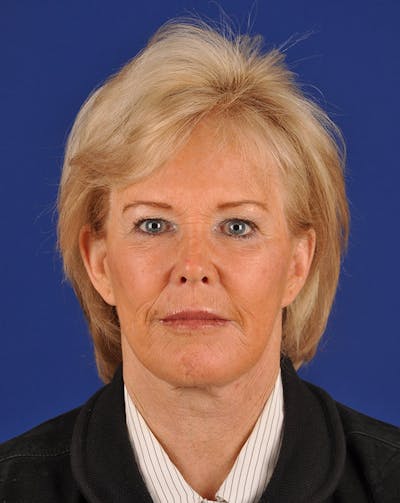 Facelift Before & After Gallery - Patient 10669959 - Image 2