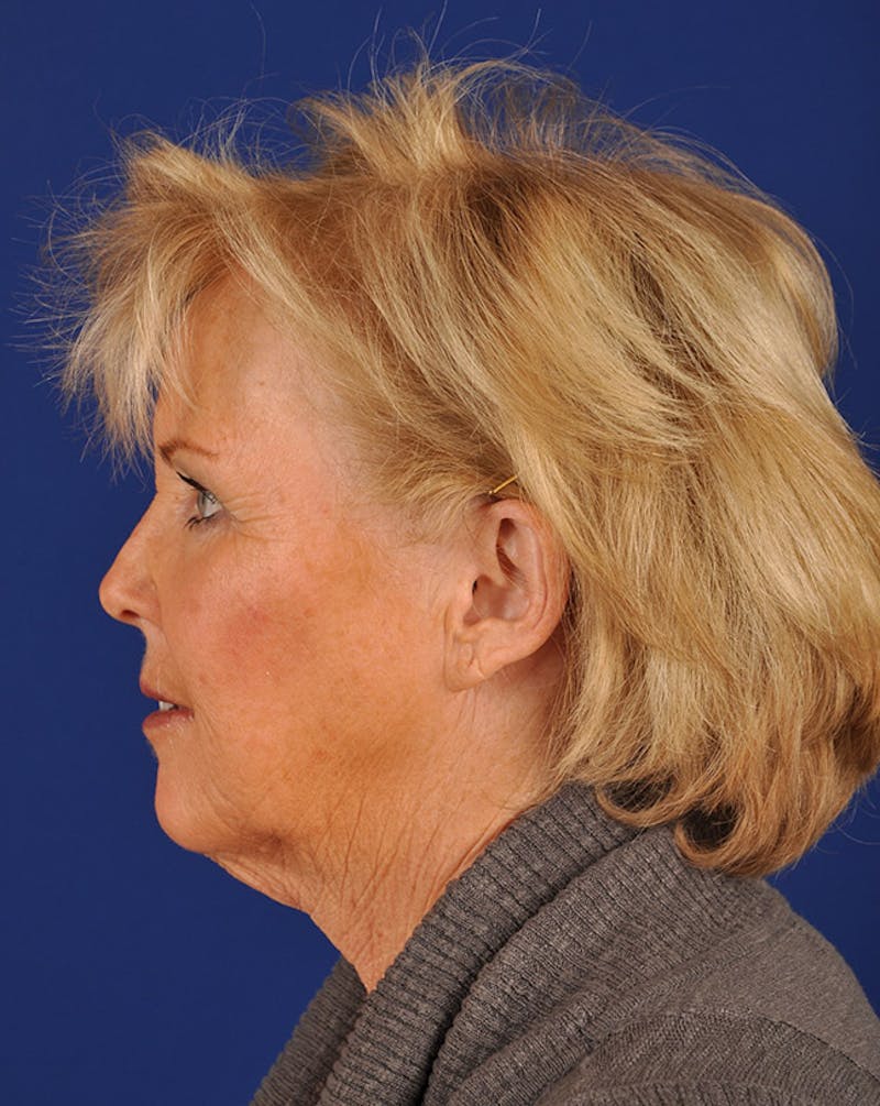Facelift Before & After Gallery - Patient 10669959 - Image 5