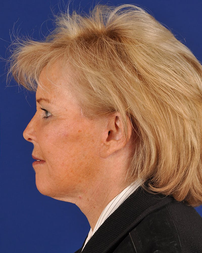 Facelift Before & After Gallery - Patient 10669959 - Image 6