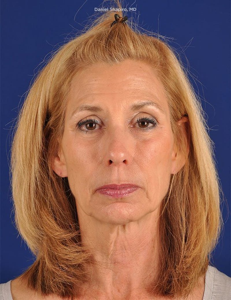 Facelift Before & After Gallery - Patient 10669961 - Image 1