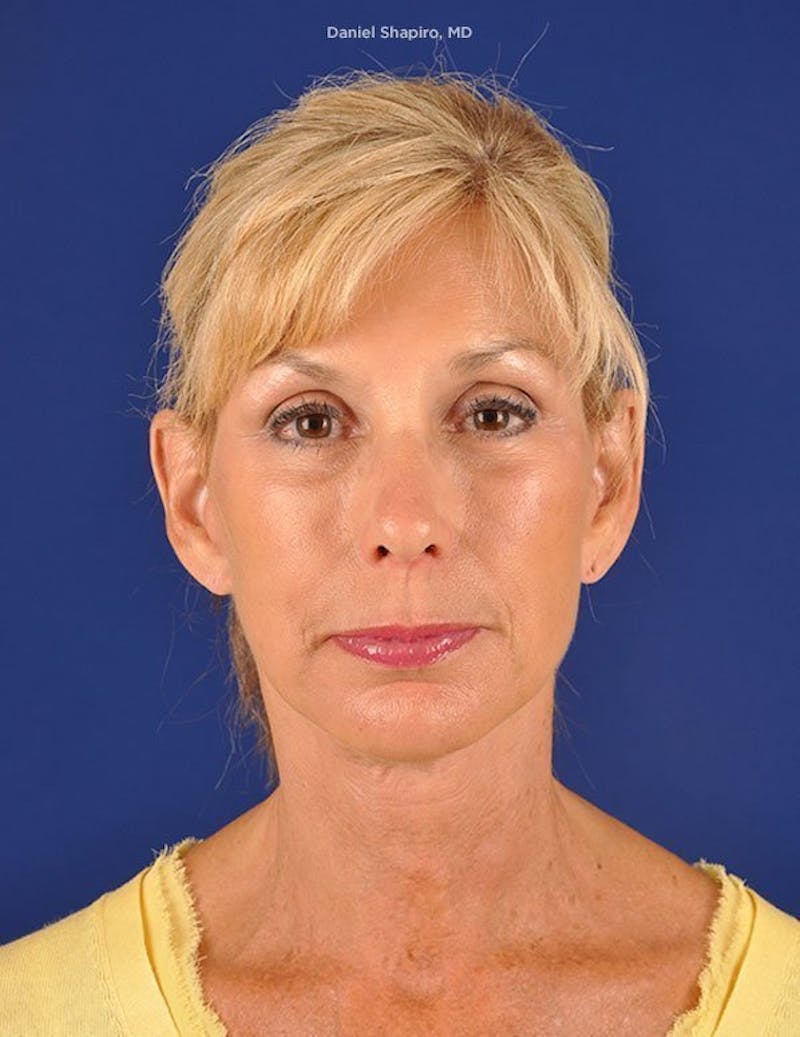 Facelift Before & After Gallery - Patient 10669961 - Image 2