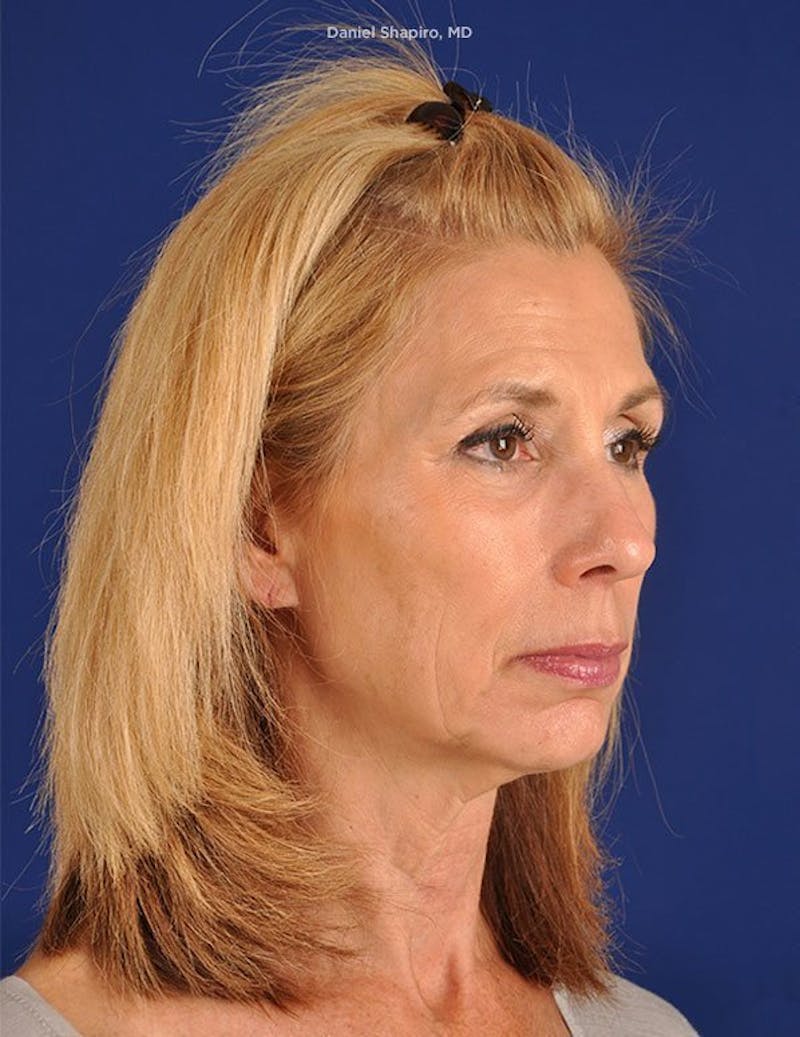 Facelift Before & After Gallery - Patient 10669961 - Image 3