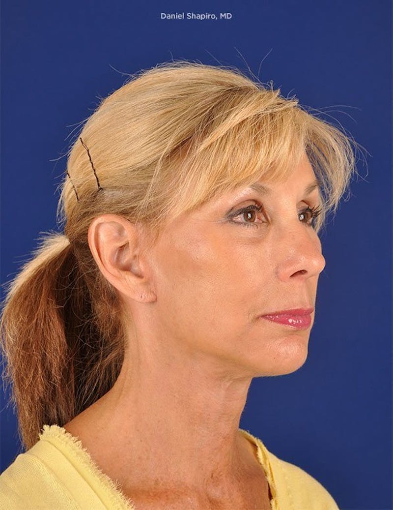 Facelift Before & After Gallery - Patient 10669961 - Image 4