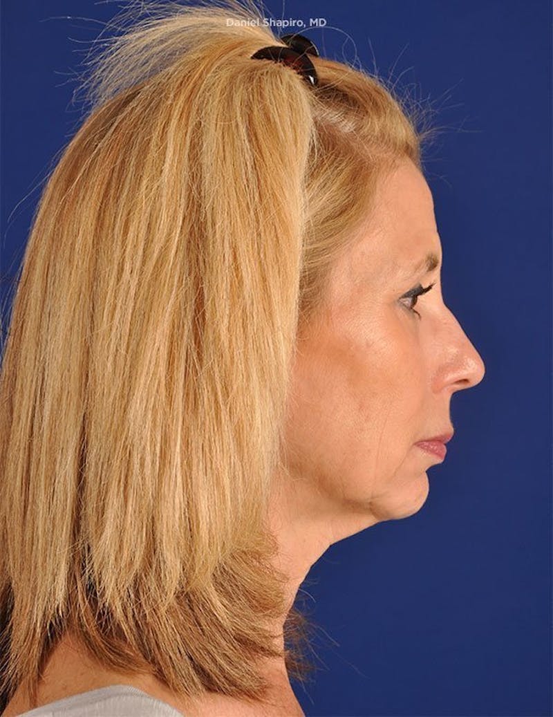 Facelift Before & After Gallery - Patient 10669961 - Image 5