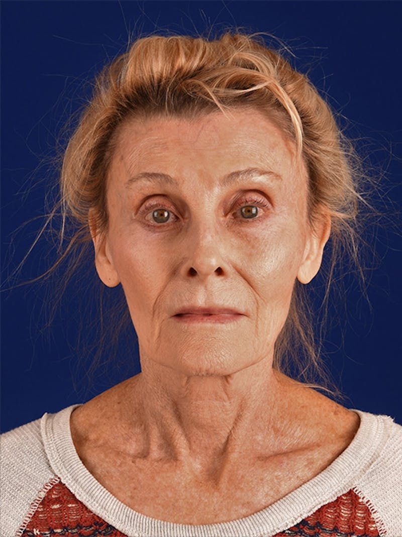 Facelift Before & After Gallery - Patient 10669962 - Image 1