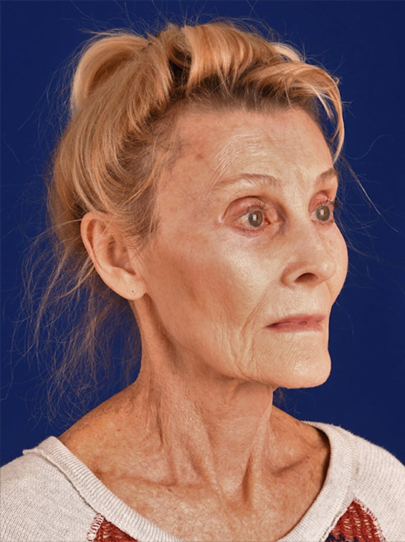 Facelift Before & After Gallery - Patient 10669962 - Image 3