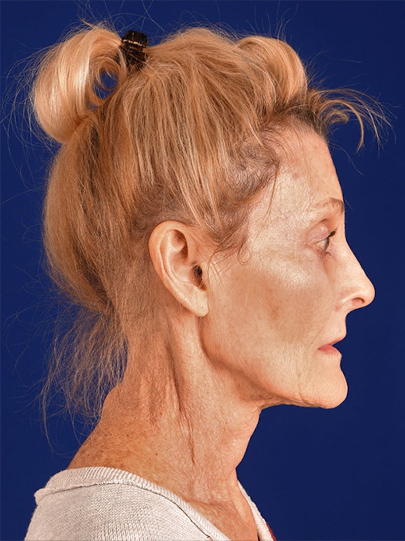 Facelift Before & After Gallery - Patient 10669962 - Image 5