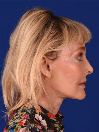 Facelift Before & After Gallery - Patient 10669962 - Image 6
