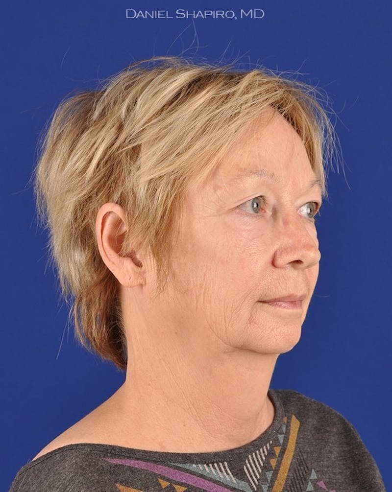 Facelift Before & After Gallery - Patient 10669974 - Image 3