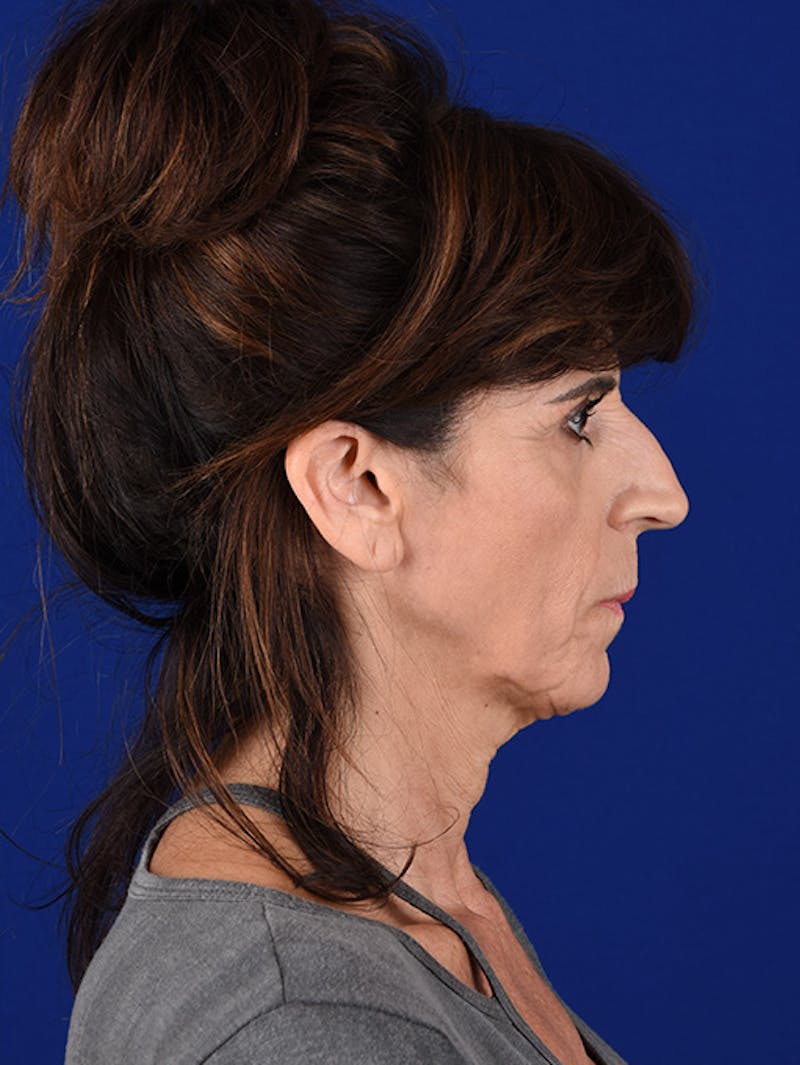 Facelift Before & After Gallery - Patient 10669975 - Image 5