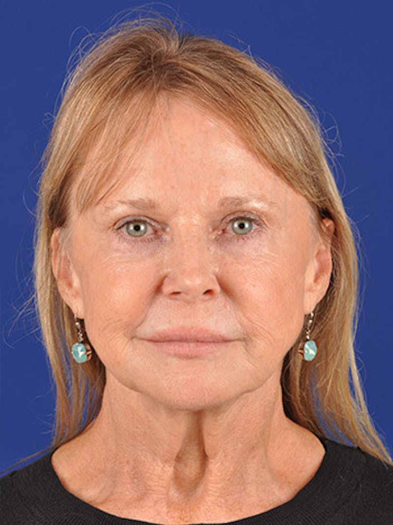 Facelift Before & After Gallery - Patient 10669976 - Image 1