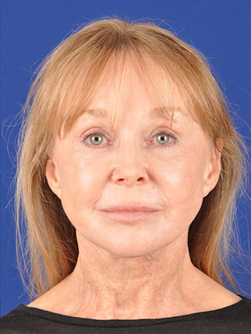 Facelift Before & After Gallery - Patient 10669976 - Image 2