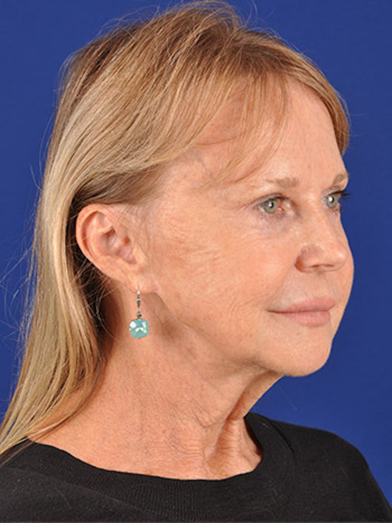 Facelift Before & After Gallery - Patient 10669976 - Image 3