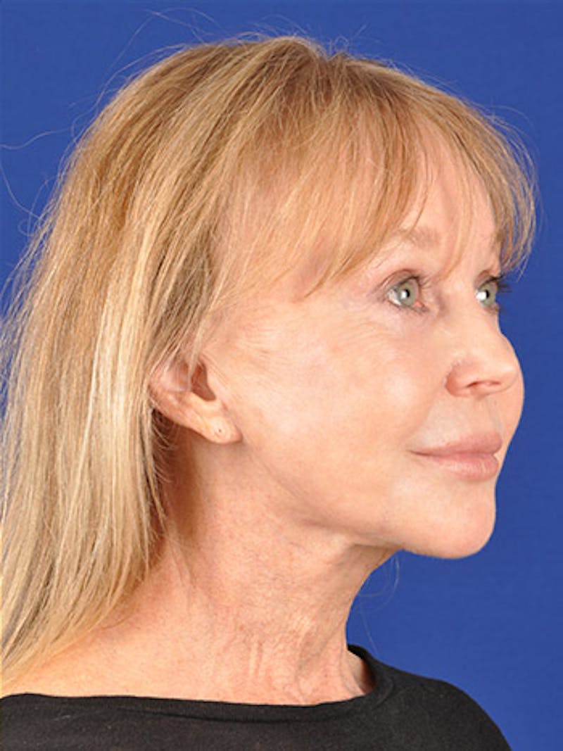 Facelift Before & After Gallery - Patient 10669976 - Image 4