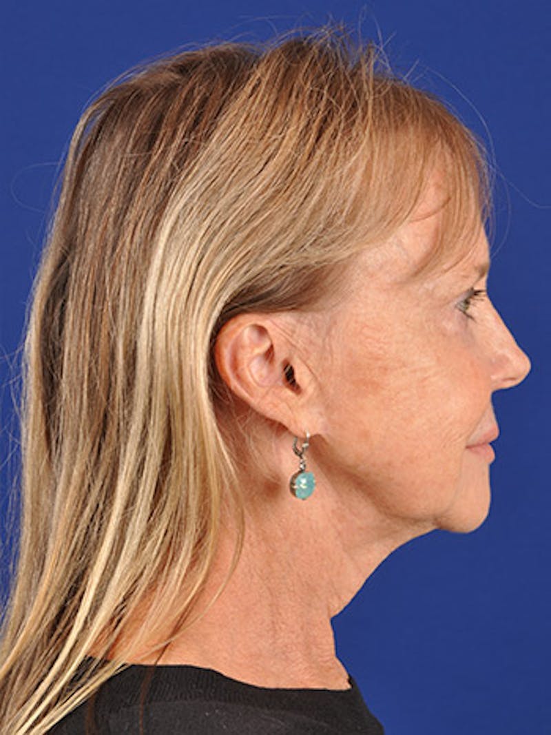Facelift Before & After Gallery - Patient 10669976 - Image 5