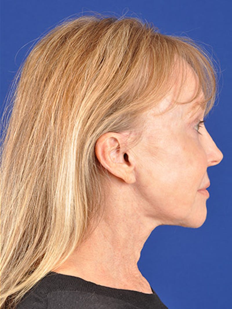 Facelift Before & After Gallery - Patient 10669976 - Image 6