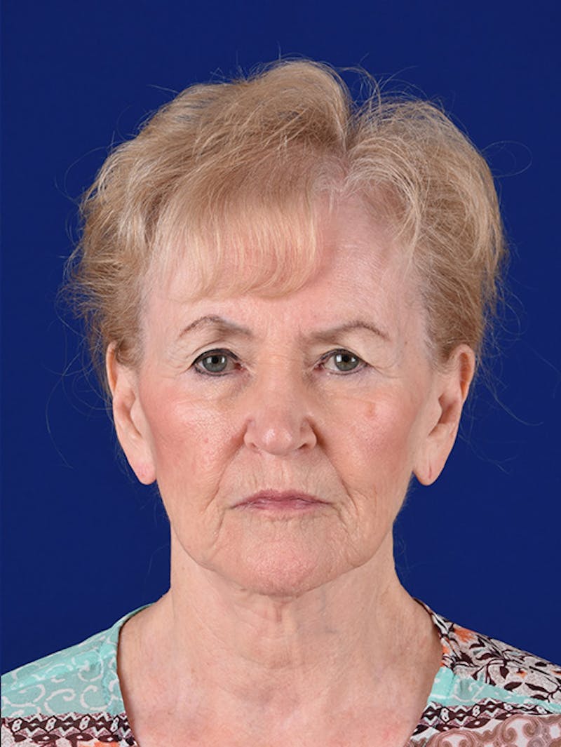 Facelift Before & After Gallery - Patient 10669977 - Image 1
