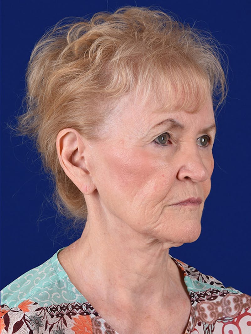 Facelift Before & After Gallery - Patient 10669977 - Image 3