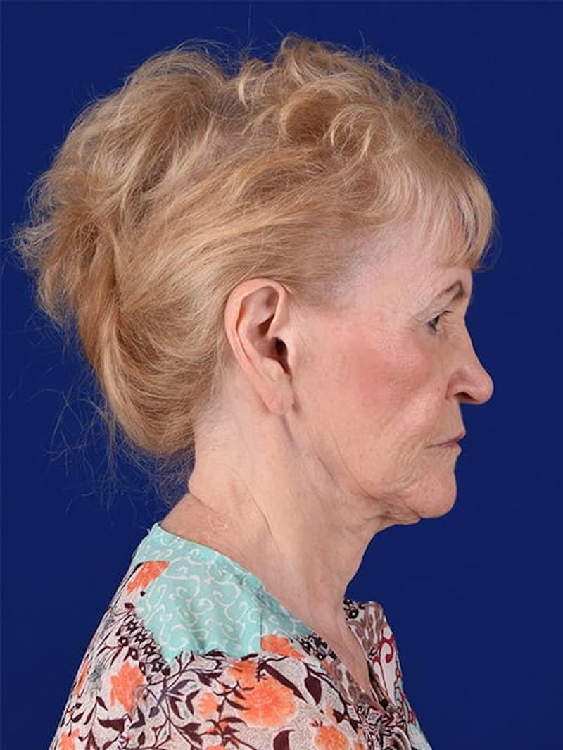 Facelift Before & After Gallery - Patient 10669977 - Image 5