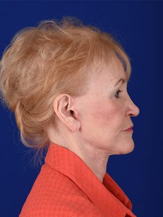 Facelift Before & After Gallery - Patient 10669977 - Image 6