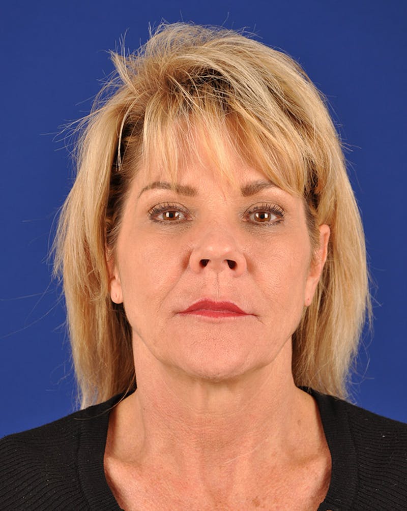 Facelift Before & After Gallery - Patient 10669979 - Image 1