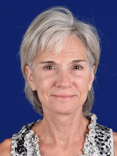 Facelift Before & After Gallery - Patient 10669980 - Image 2