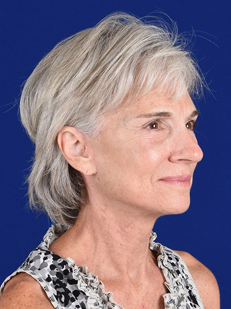 Facelift Before & After Gallery - Patient 10669980 - Image 4