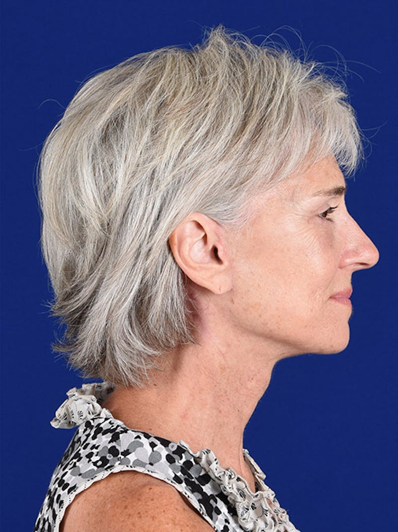 Facelift Before & After Gallery - Patient 10669980 - Image 6