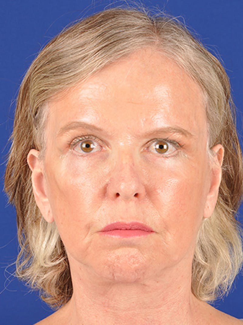 Facelift Before & After Gallery - Patient 10669983 - Image 2
