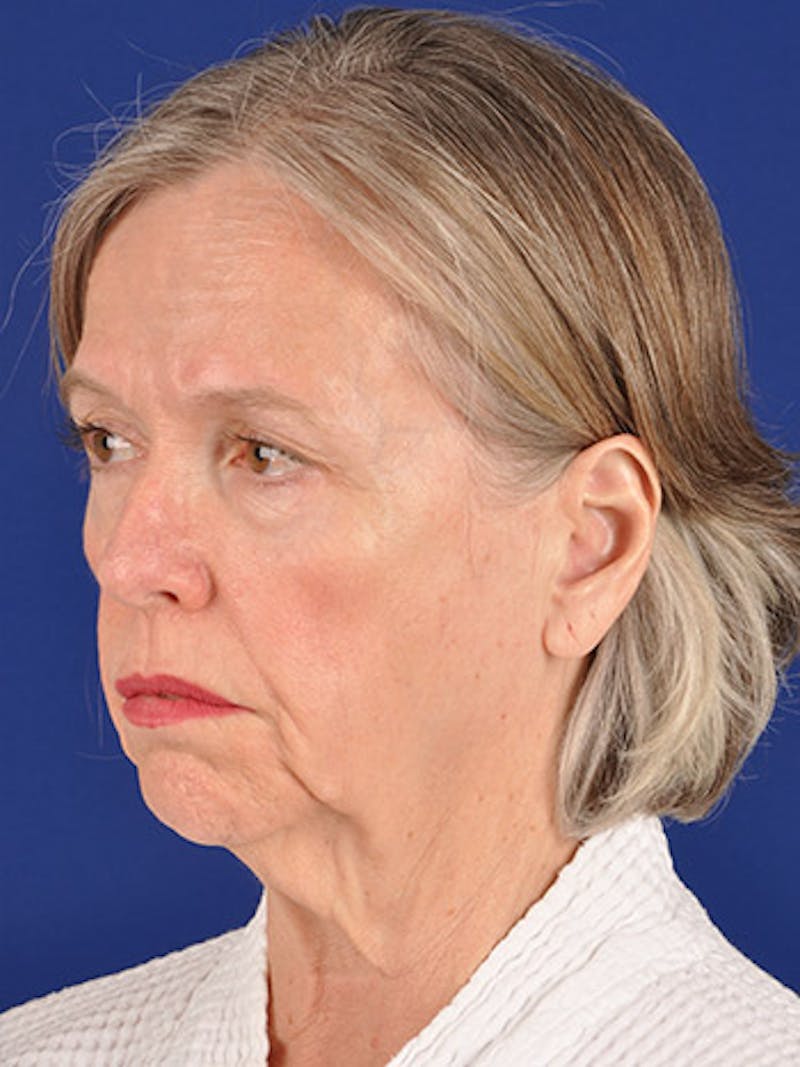 Facelift Before & After Gallery - Patient 10669983 - Image 3