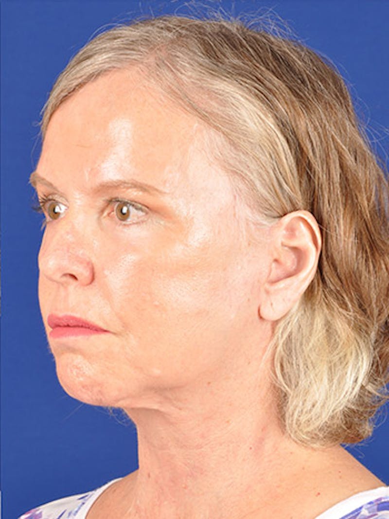 Facelift Before & After Gallery - Patient 10669983 - Image 4