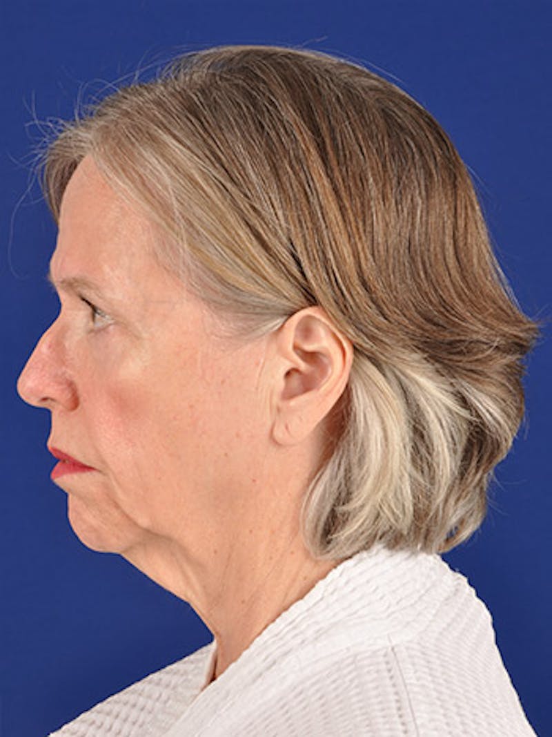 Facelift Before & After Gallery - Patient 10669983 - Image 5