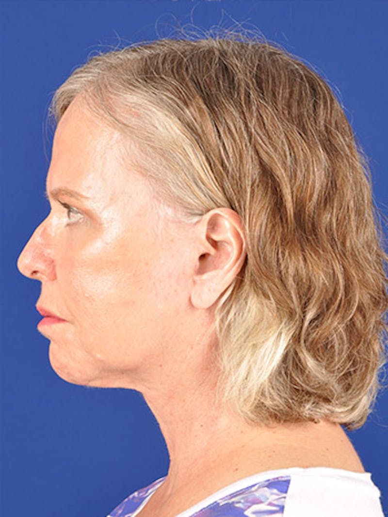 Facelift Before & After Gallery - Patient 10669983 - Image 6