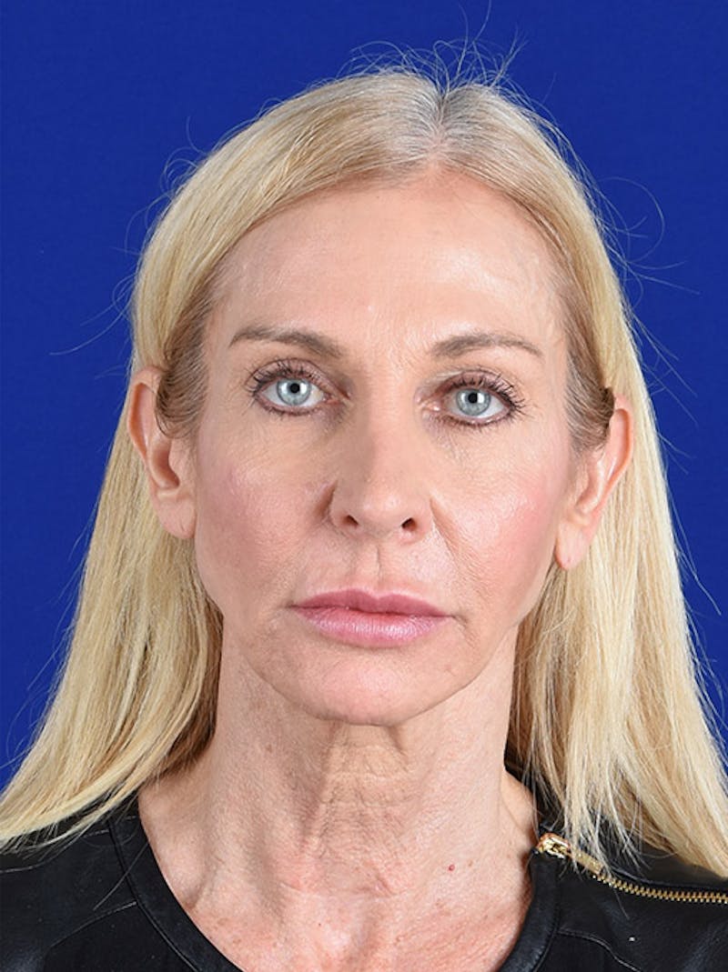 Facelift Before & After Gallery - Patient 10669986 - Image 1