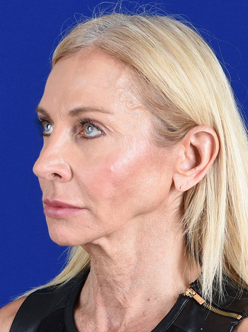 Facelift Before & After Gallery - Patient 10669986 - Image 3