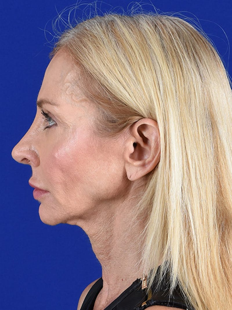 Facelift Before & After Gallery - Patient 10669986 - Image 5