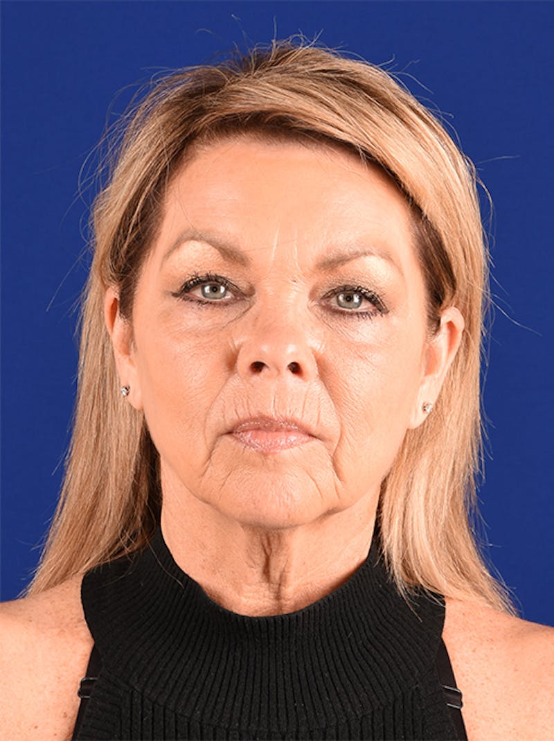 Facelift Before & After Gallery - Patient 10669990 - Image 1