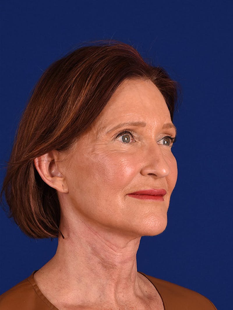 Facelift Before & After Gallery - Patient 10669994 - Image 4