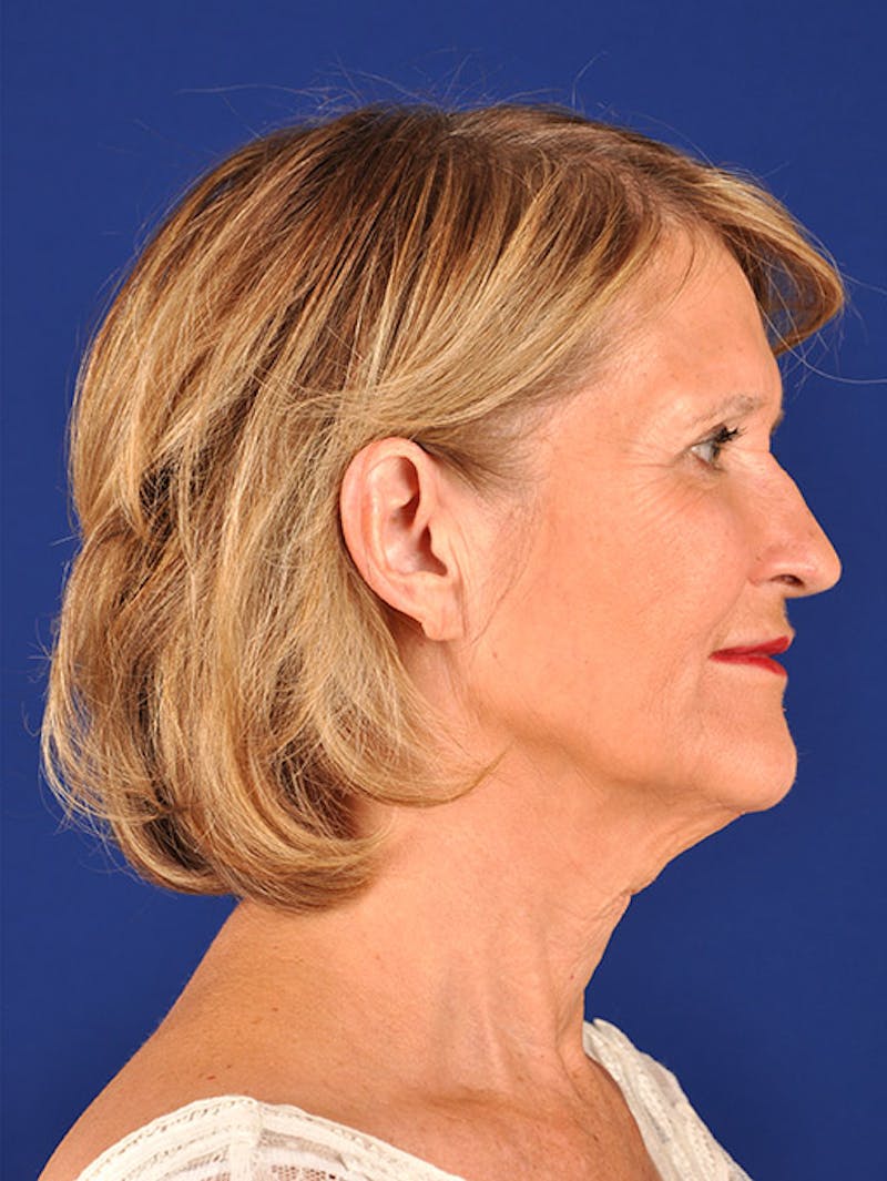 Facelift Before & After Gallery - Patient 10669994 - Image 5