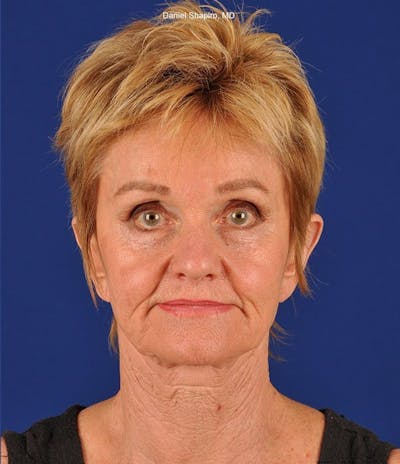 Facelift Before & After Gallery - Patient 10670003 - Image 1