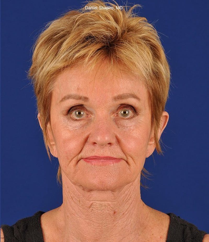 Facelift Before & After Gallery - Patient 10670003 - Image 1