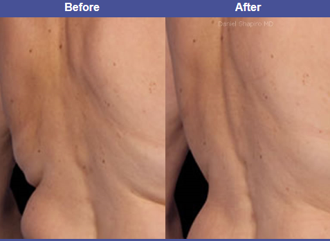Coolsculpting by dr shapiro