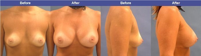 breast enhancement with drshapiro