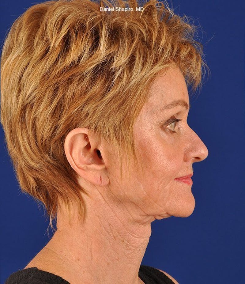 Facelift Before & After Gallery - Patient 10670003 - Image 5