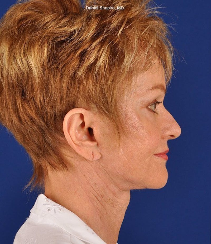 Facelift Before & After Gallery - Patient 10670003 - Image 6