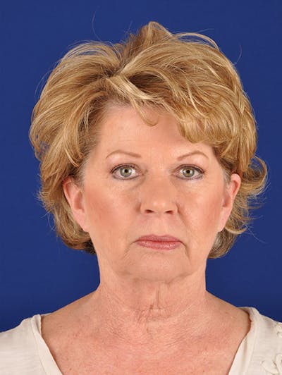 Facelift Before & After Gallery - Patient 10670008 - Image 1