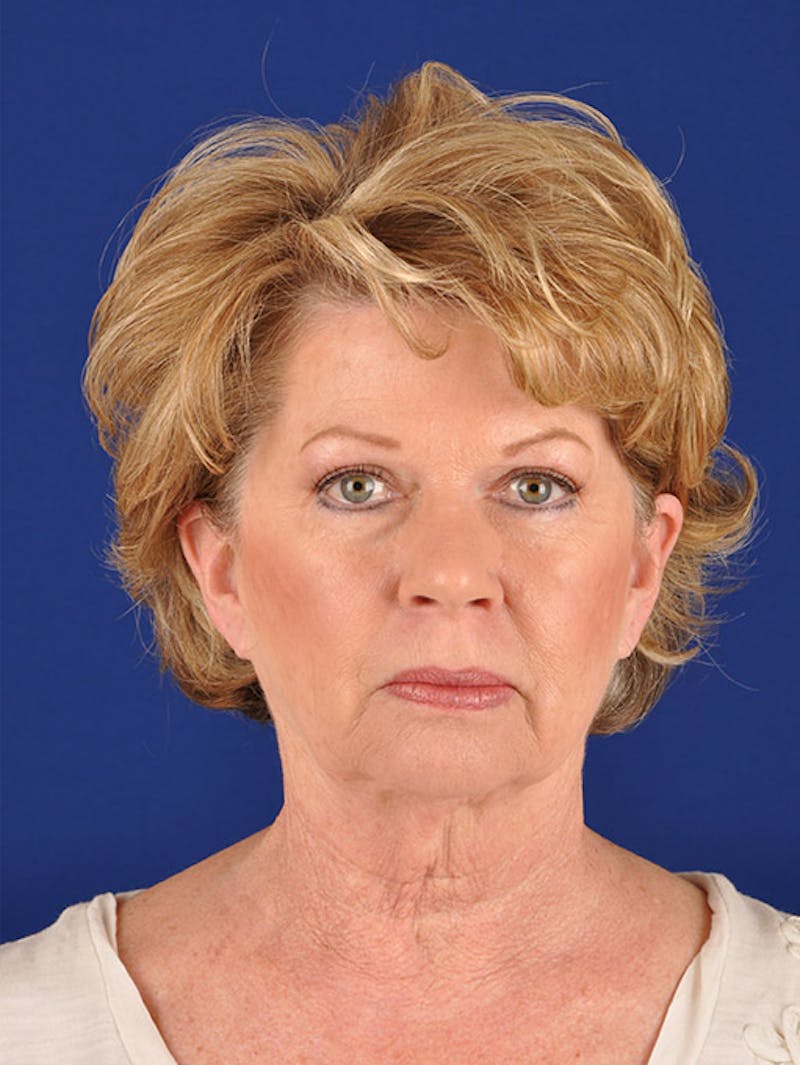 Facelift Before & After Gallery - Patient 10670008 - Image 1