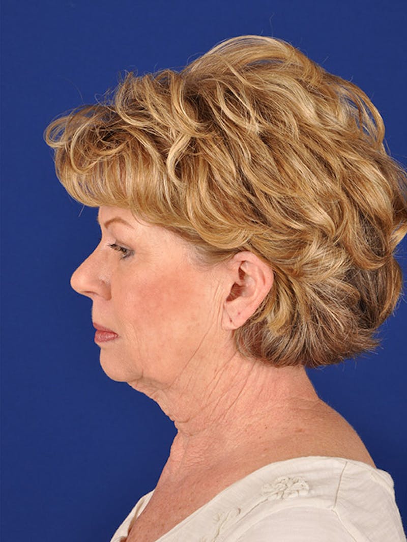 Facelift Before & After Gallery - Patient 10670008 - Image 5