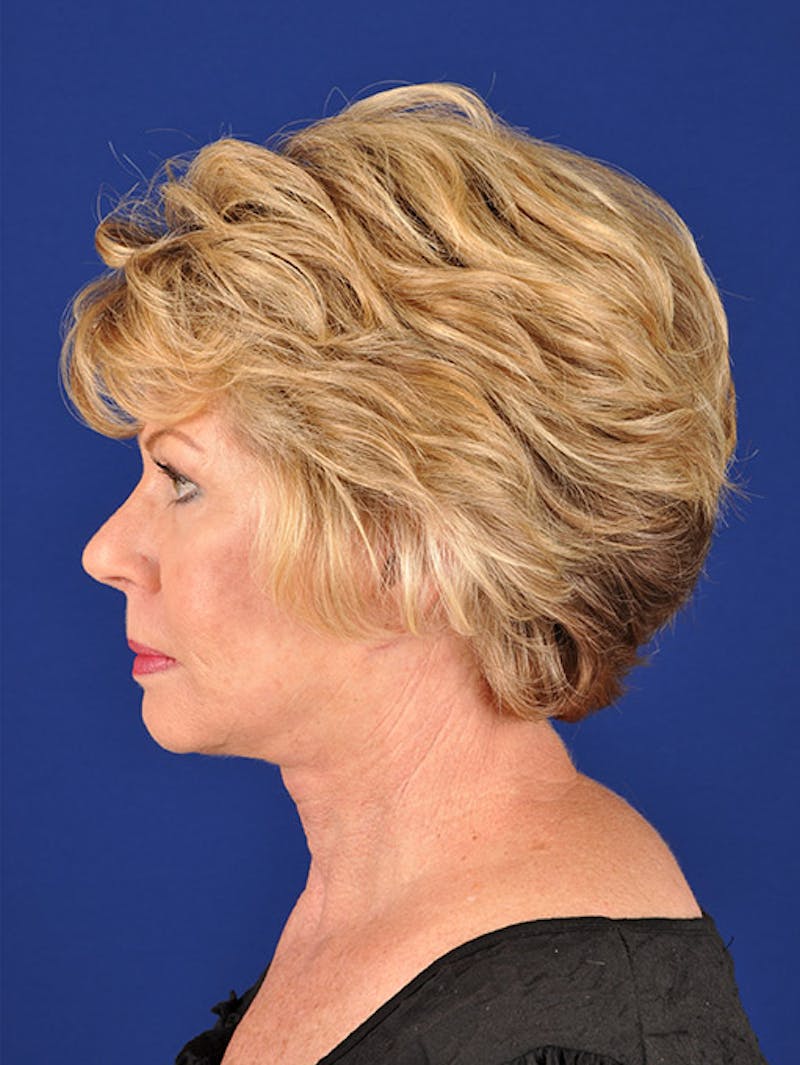 Facelift Before & After Gallery - Patient 10670008 - Image 6