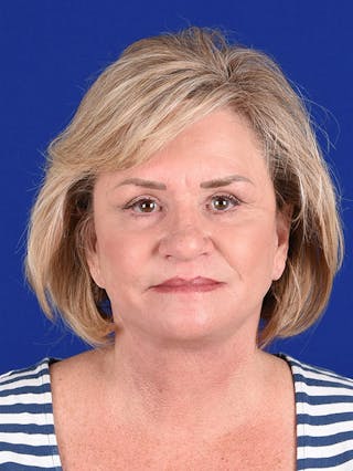Facelift Before & After Gallery - Patient 10670015 - Image 2